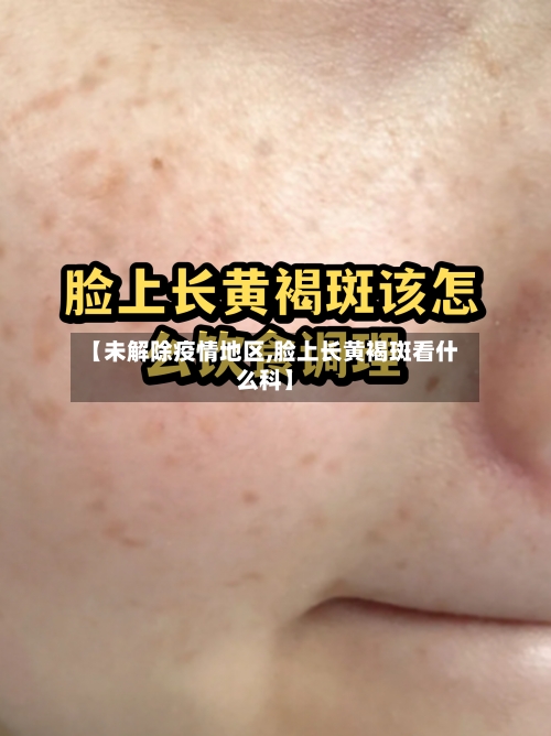 【未解除疫情地区,脸上长黄褐斑看什么科】-第2张图片